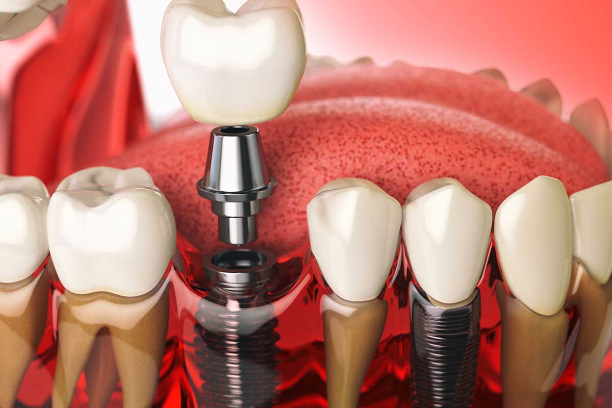 digital model showing how dental implants can help restore smiles