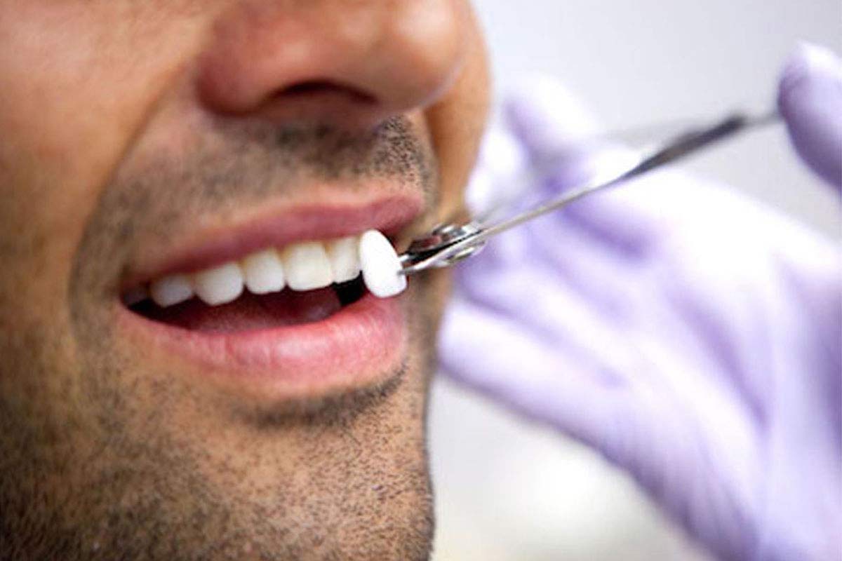 patient deciding which color dental veneer he would like